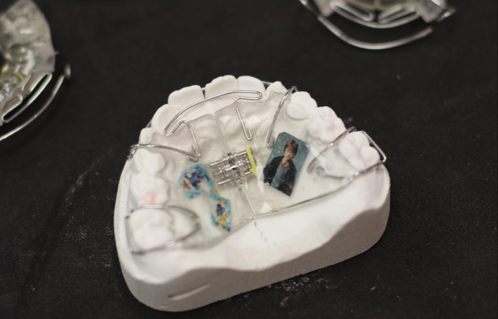 aparat ortodontyczny wyjmowany